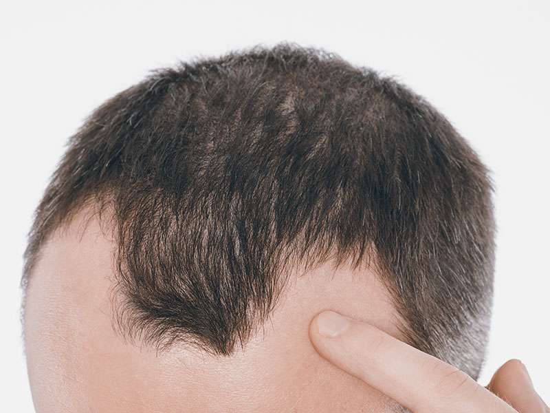 Alopecia Androgenética Masculina