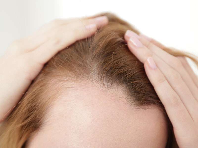 Alopecia Androgenética Femenina