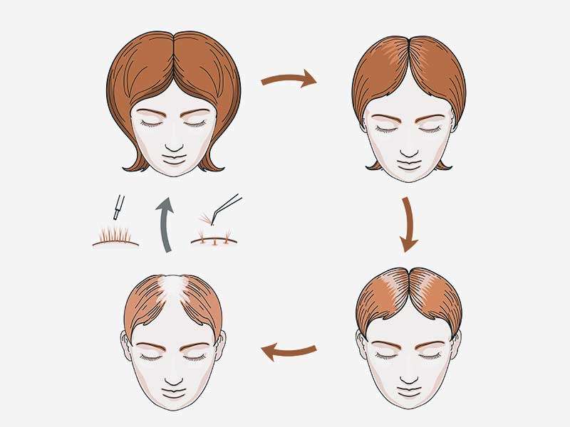 La caída del cabello en la mujer: Calvicie de patrón femenino y más