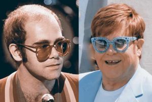Elton John Injerto de pelo
