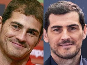 Iker Casillas Injerto de pelo