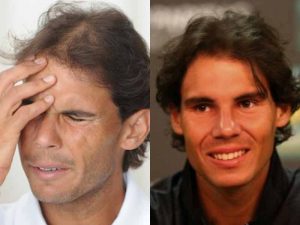 Rafael Nadal trasplante pelo