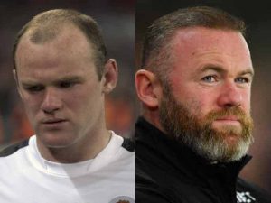 Wayne Rooney Injerto de cabello