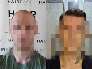 injerto capilar resultado después de 1 año