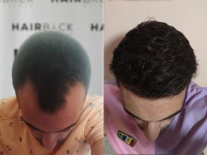 Resultados injerto capilar en Turquía