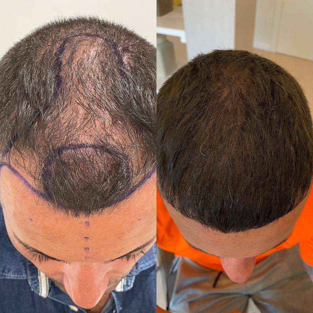 HairBack Clinic España resultados antes y después injerto capilar