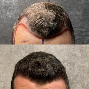 HairBack Clinic España resultados antes y después injerto capilar