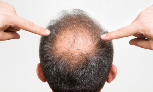 Alopecia Masculina- Caída Del Cabello En Los Hombres