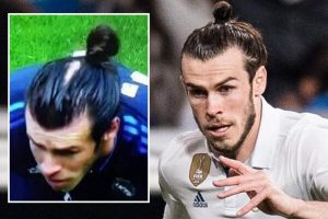 Gareth Bale Trasplante Capilar – Antes y Después
