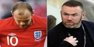 Wayne Rooney Trasplante Capilar – Antes y Después