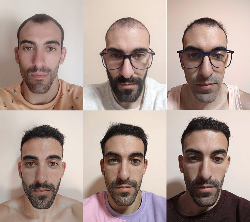 Resultado injerto capilar Turquía antes y después HairBack Clinic