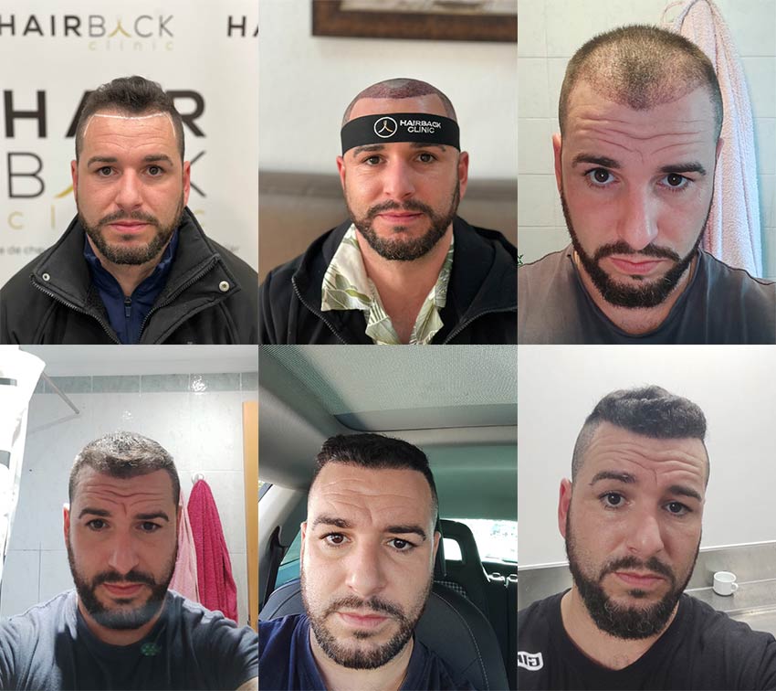 Resultado injerto capilar Turquía antes y después HairBack Clinic