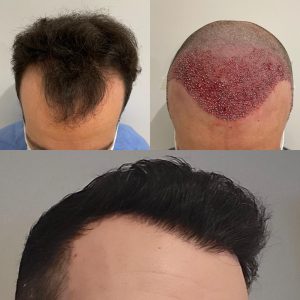 Resultados de su Trasplante de Cabello Resultado injerto capilar Turquía antes y después HairBack Clinic