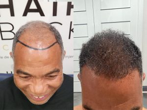 Resultados de su Trasplante de Cabello Resultado injerto capilar Turquía antes y después HairBack Clinic