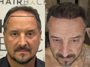 Resultados de su Trasplante de Cabello Resultado injerto capilar Turquía antes y después HairBack Clinic