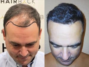 Resultados de su Trasplante de Cabello Resultado injerto capilar Turquía antes y después HairBack Clinic