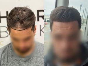 Resultados de su Trasplante de Cabello Resultado injerto capilar Turquía antes y después HairBack Clinic