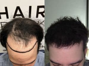 Resultados de su Trasplante de Cabello Resultado injerto capilar Turquía antes y después HairBack Clinic trasplante de cabello en Estambul