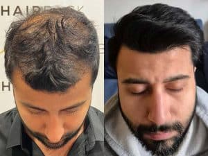 resultado trasplante capilar en turquía