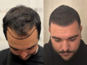 resultado trasplante capilar en turquía 2025