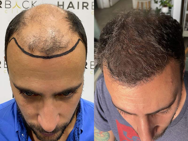 resultado injerto pelo turquia 2025