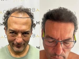 resultado injerto capilar 6 meses FUE Zafiro