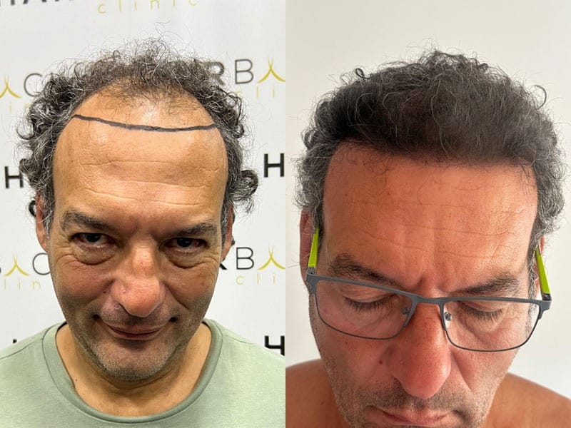 resultado injerto capilar 6 meses FUE Zafiro