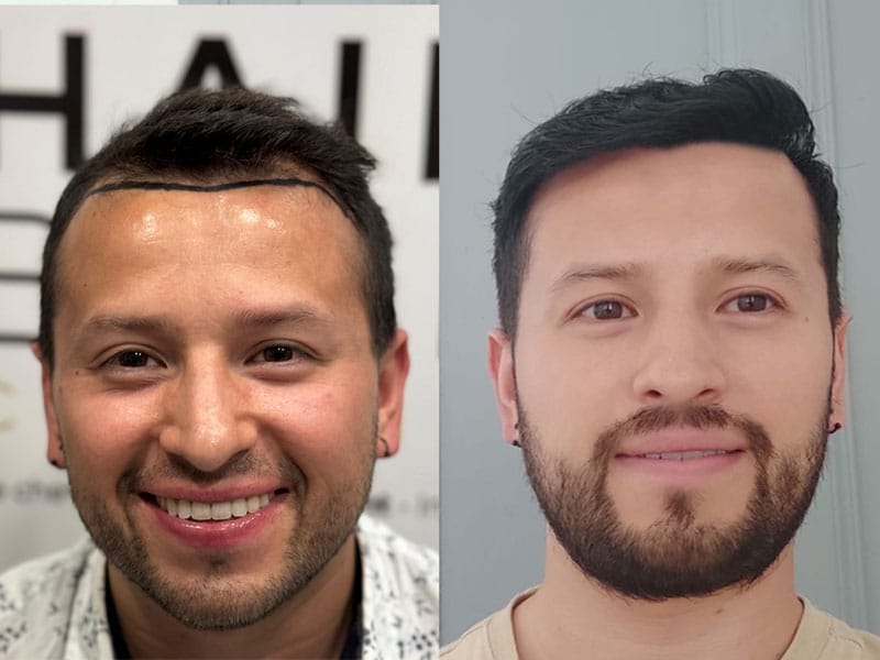 Resultado injerto capilar técnica DHI