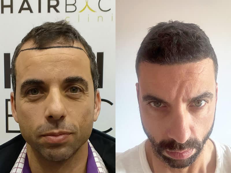 Resultado injerto capilar Turquía 2000 folículos DHI Injerto capilar en Sitges