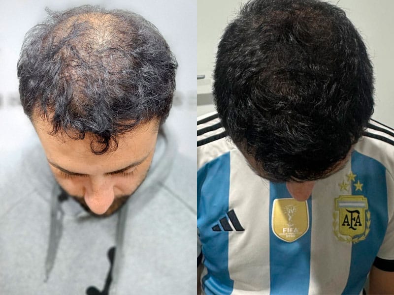 Resultado injerto capilar Turquía 3500 folículos DHI