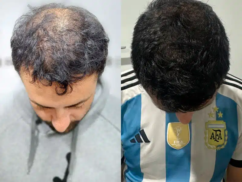 Resultado injerto capilar Turquía 3500 folículos DHI