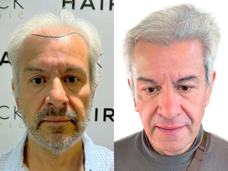 Resultado injerto capilar Turquía 2750 folículos DHI