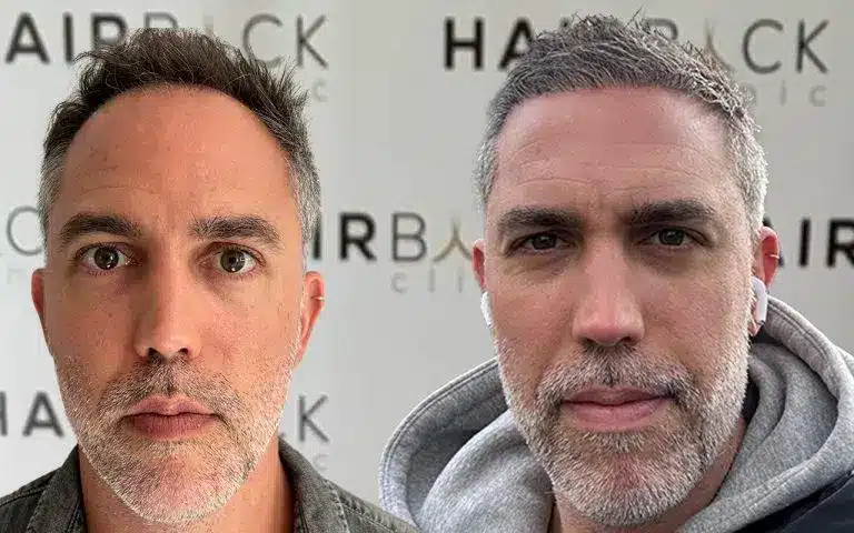 Resultado injerto capilar Turquía 3000 folículos DHI